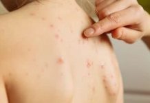 Gangguan Kesehatan Campak Dialami, Coba Sinergi Rempah Ini Diminum – Mungkin Jadi Wasilah Kesembuhan, | Tips Sehat Alami